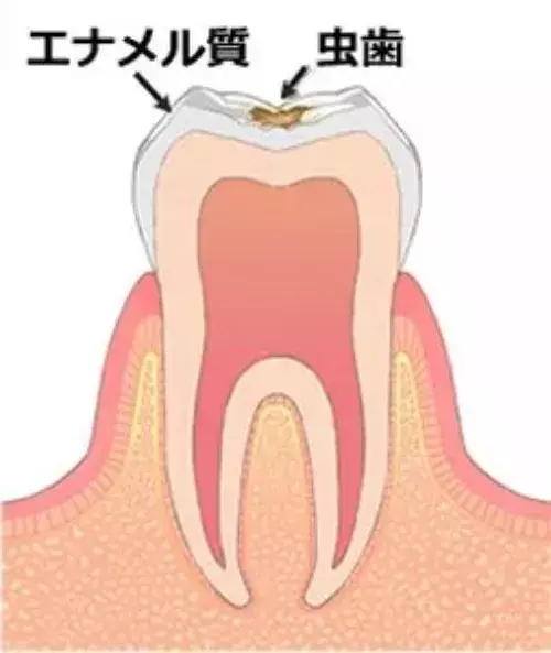 C0 初期の虫歯