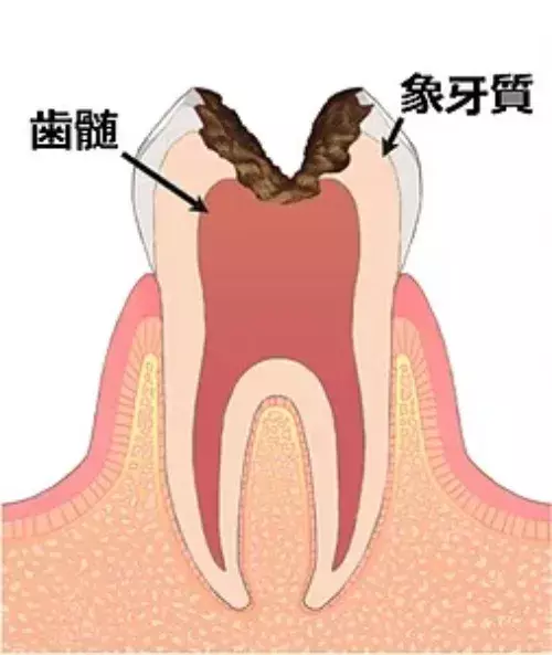 C3 神経に進行した虫歯
