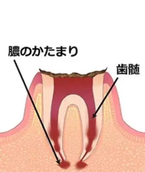 C4 歯根に進行した虫歯